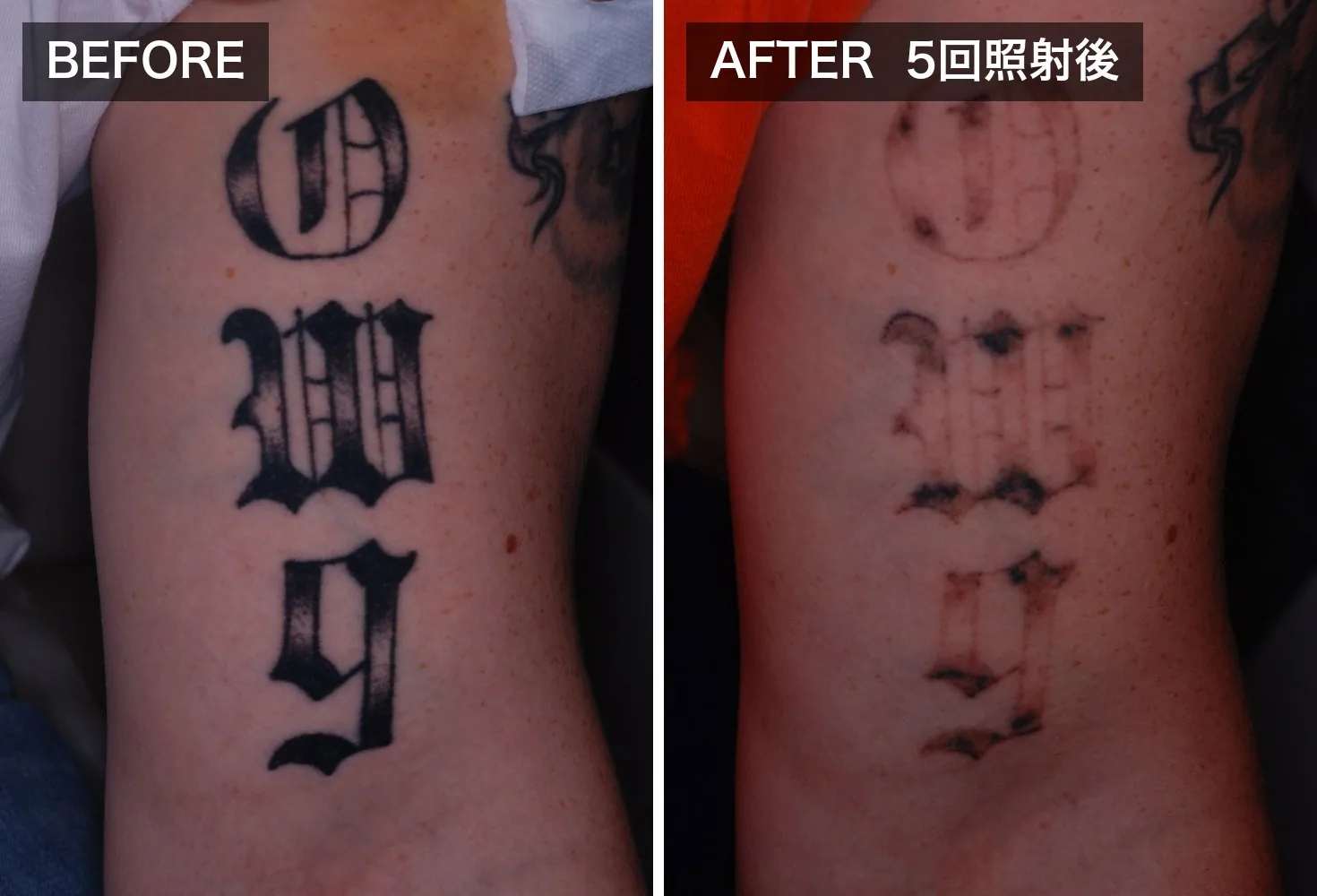 タトゥー除去（刺青除去）｜医療レーザーによる施術 | inklinic
